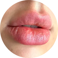 Lábios de cliente antes do uso do Lip Gloss